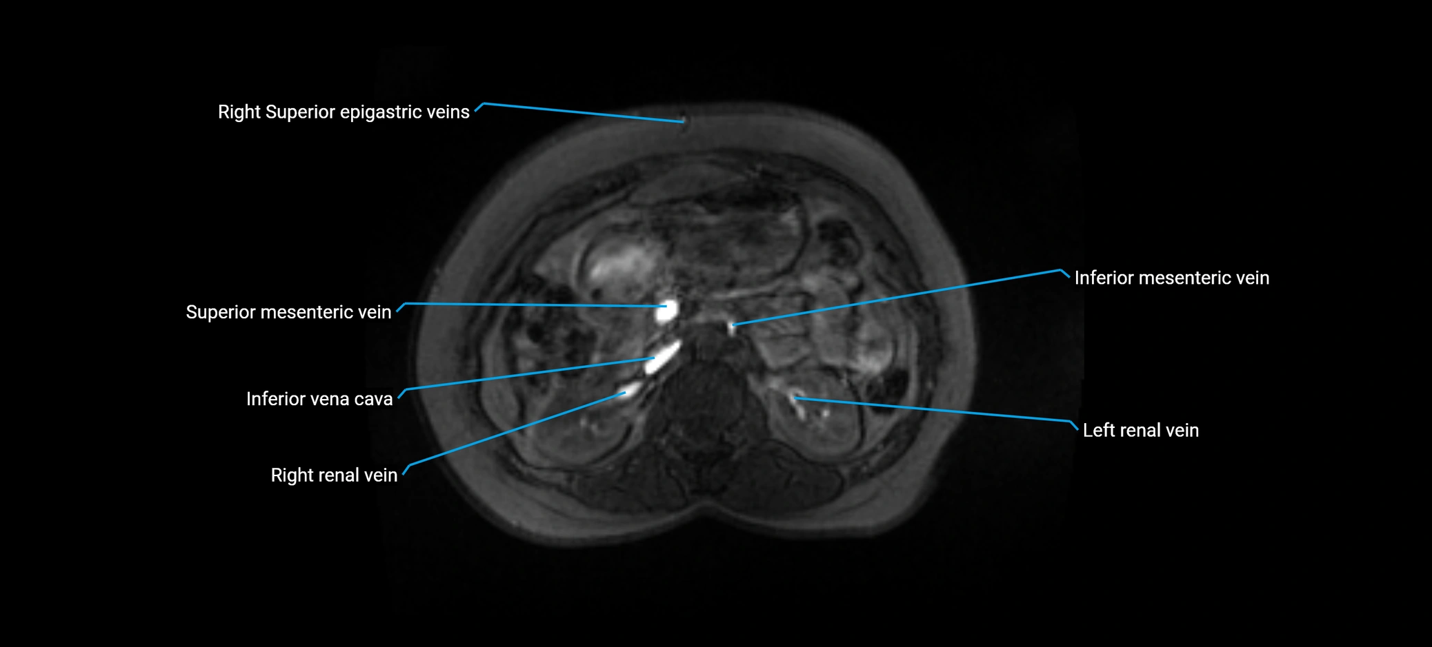 MRV abdomen pelvis & lower limb axial cross sectional anatomy labelled MRI image 67 (1).webp